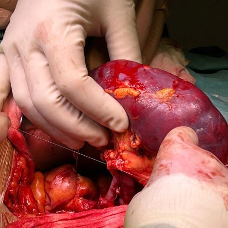 Nerka w dłoniach chirurgów